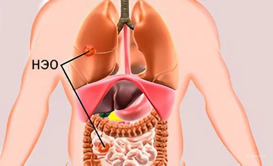 ⚡️ 10 НОЯБРЯ – МЕЖДУНАРОДНЫЙ ДЕНЬ НЕЙРОЭНДОКРИННОГО РАКА (НЭО)